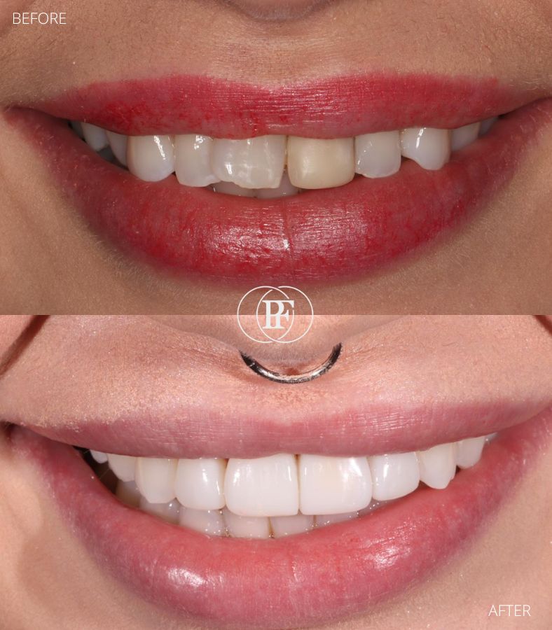 Composite Bonding Close Gaps Between Teeth