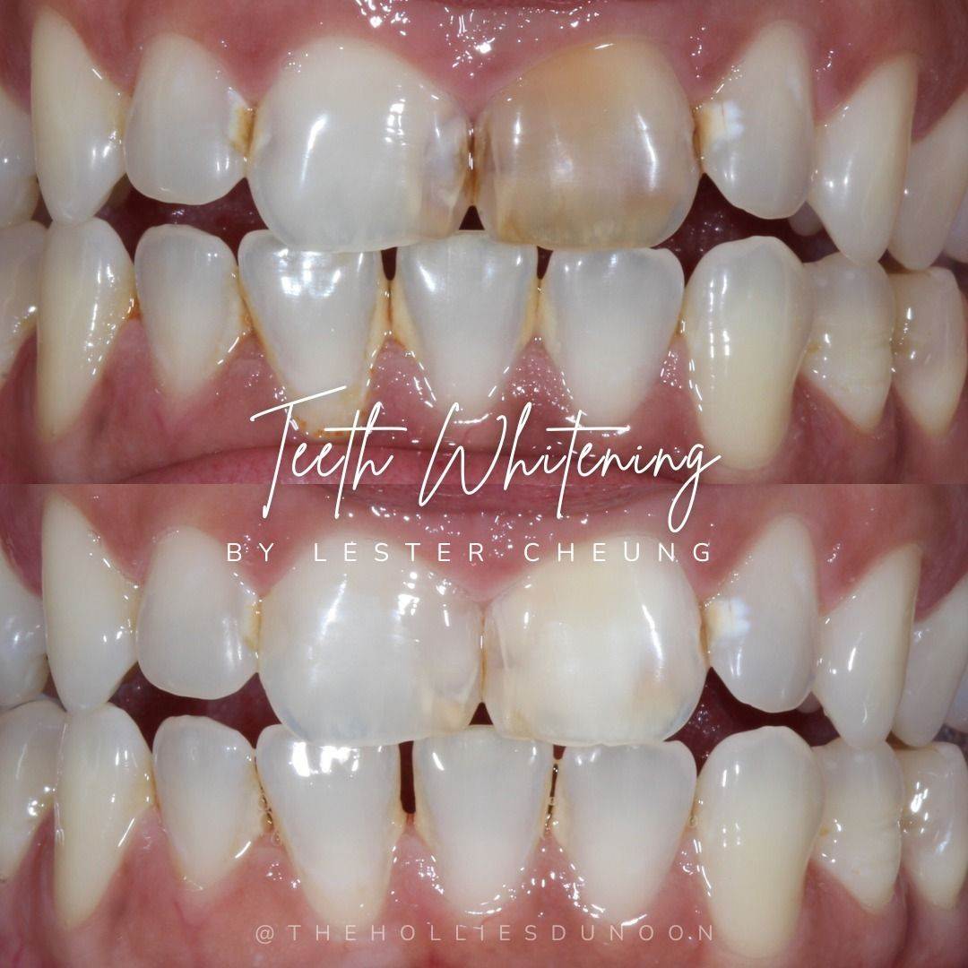 The Hollies Dental Practice Tooth whitening The Hollies Dental Practice Tooth whitening