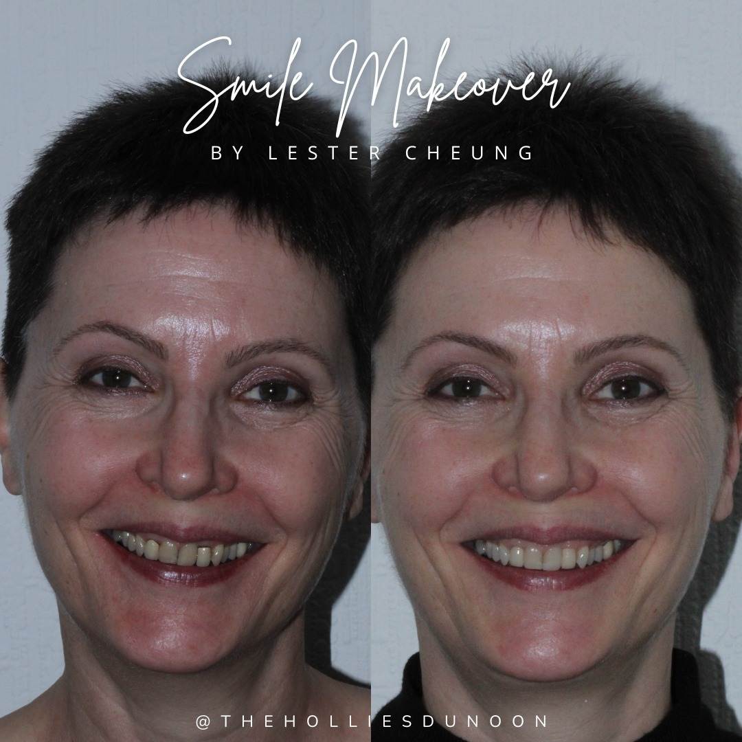 The Hollies Dental Practice Smile Makeovers in Dunoon The Hollies Dental Practice Smile Makeovers in Dunoon