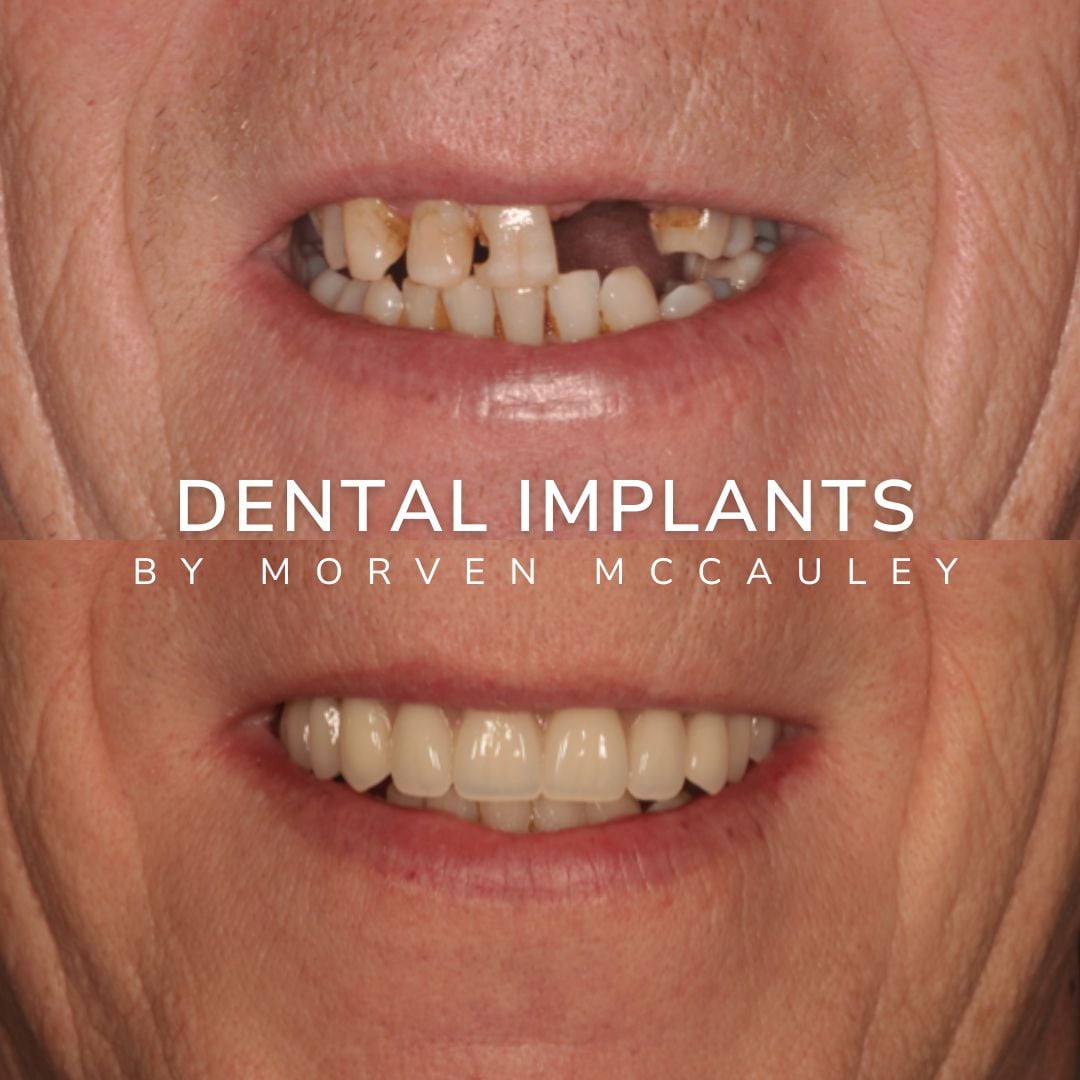 The Hollies Dental Practice Dental Implants Dunoon The Hollies Dental Practice Dental Implants Dunoon