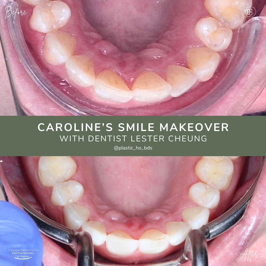 The Hollies Dental Practice Caroline's Smile Story The Hollies Dental Practice Caroline's Smile Story